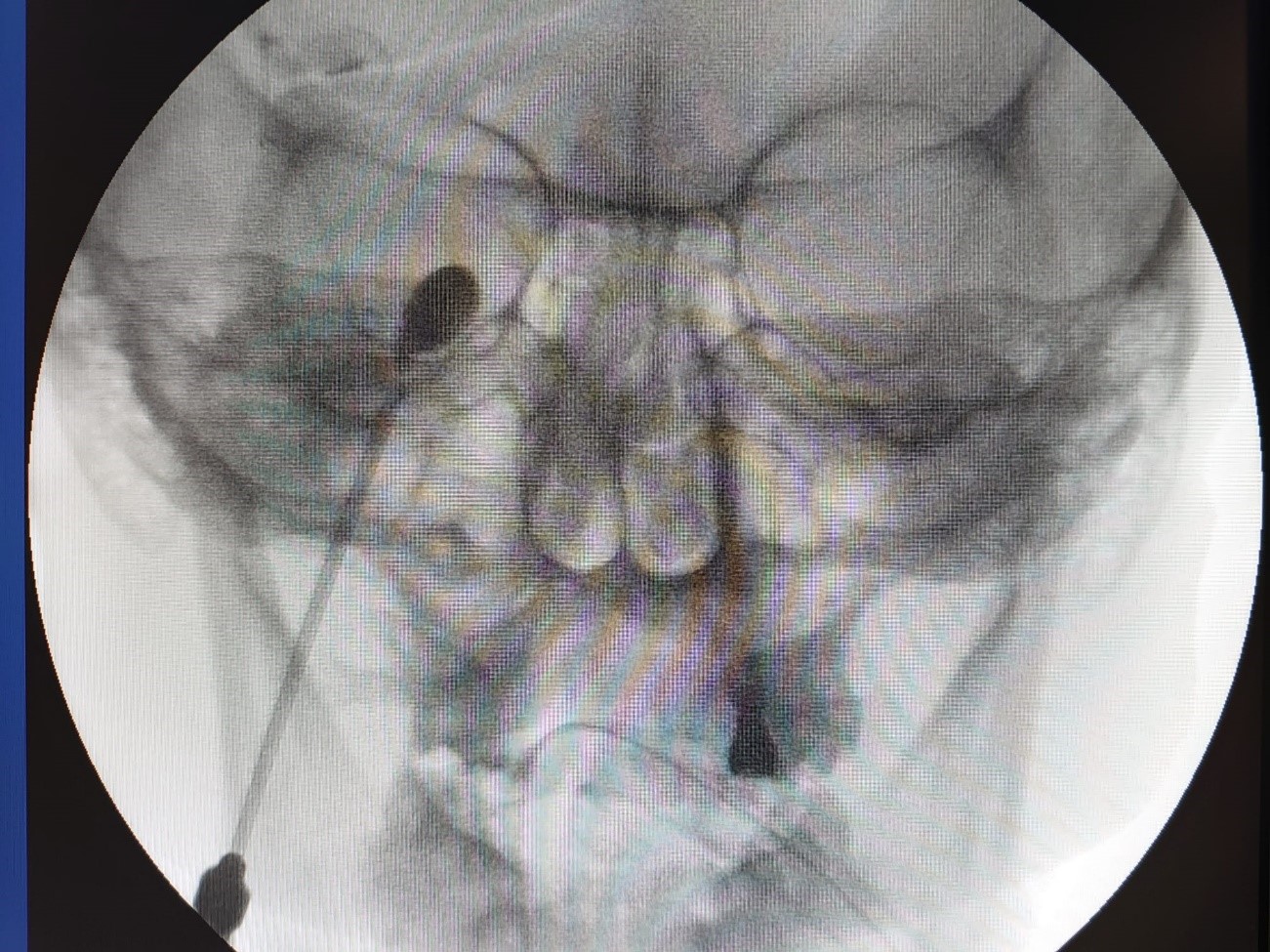 neuralgiaTrigemino2